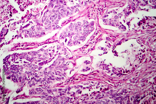 Lung adenocarcinoma, light micrograph, photo under microscope photo