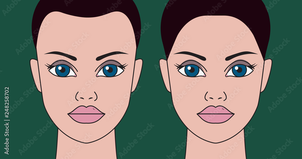 Hair transplantation in women Hair transplantation in women