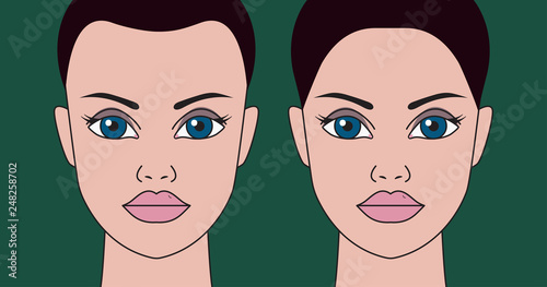 Hair transplantation in women
