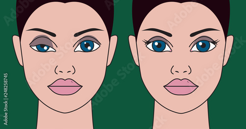 Ptosis of eyelid