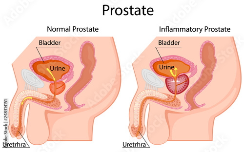 Medical illustration of the effects of prostatitis