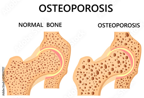 Hip bone. healthy and with osteoporosis