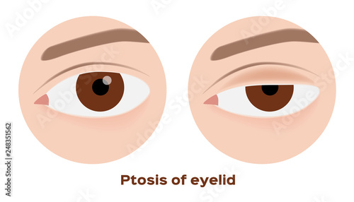 ptosis of eyelid . eye sickness  anatomy 
