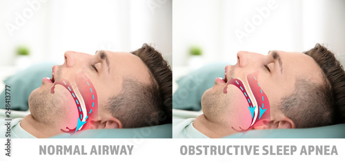 Illustrations showing difference between normal breathing and obstructive sleep apnea photo