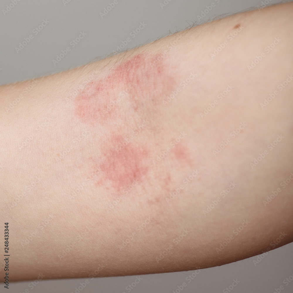 Allergy on the baby's hand close-up. Problem skin on the arm. Allergy on the baby's hand close-up. Problem skin on the arm.