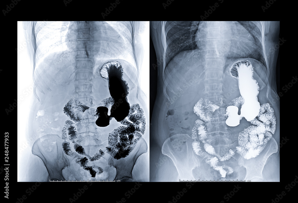 Xray image of upper gastrointestinal s a procedure in which a doctor