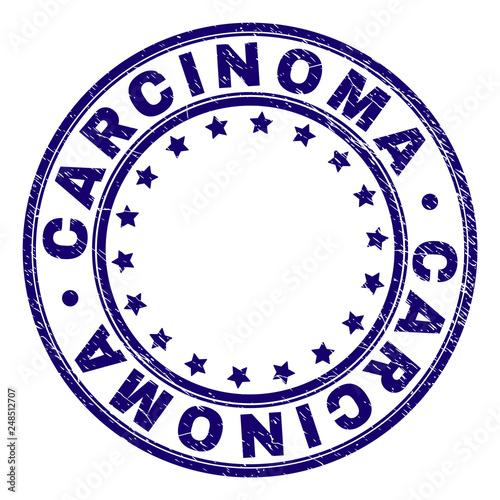 CARCINOMA stamp seal watermark with distress texture. Designed with round shapes and stars. Blue vector rubber print of CARCINOMA label with unclean texture.