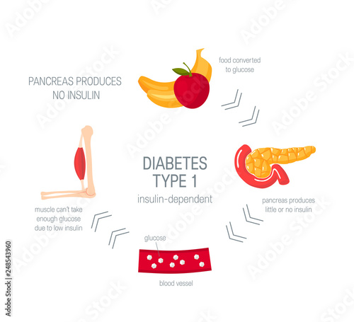 Diabetes type 1 concept in flat style, vector