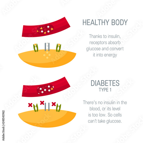 Diabetes type 1 concept in flat style, vector photo