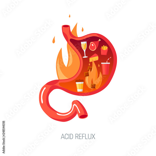 GERD concept in flat style, vector illustration