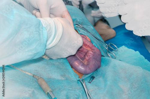 Surgery of intestinal cancer. The intestine is at the surgical field, int the hands of the surgeon. photo