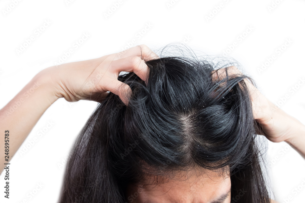 women head with dandruff Caused by the problem of dirty. Or caused by skin disease or Seborrheic Dermatitis. It has white scaly and it will cause itch. women head with dandruff Caused by the problem of dirty. Or caused by skin disease or Seborrheic Dermatitis. It has white scaly and it will cause itch.