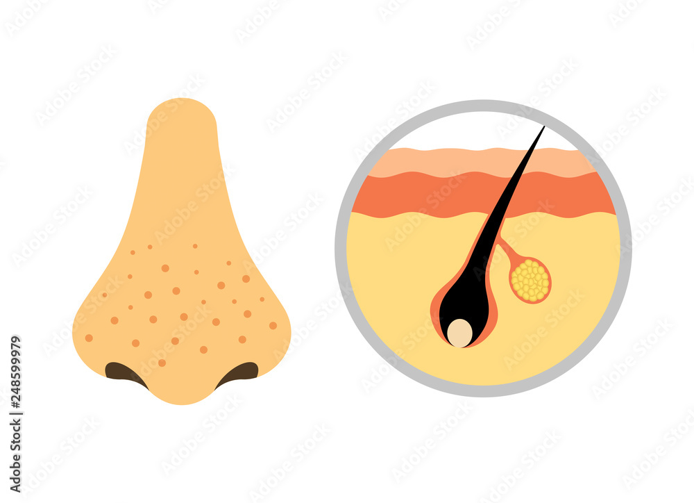 鼻の毛穴汚れ Stock イラスト Adobe Stock