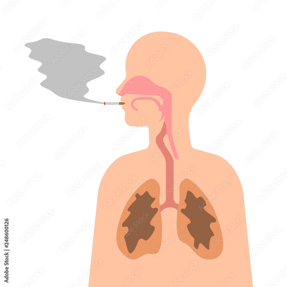喫煙者の肺 Stock イラスト Adobe Stock