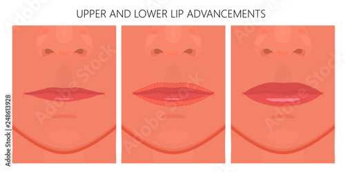 Vector illustration. Upper and Lower Lip Advancements on woman face before and after surgery. Close up view. For advertising of medicinal, cosmetic, plastic surgery, beauty procedures.