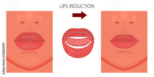 Vector illustration. Upper and lower  lip reduction before, after procedure. Close up view. For advertising of cosmetic plastic procedures; for medical and beauty publications