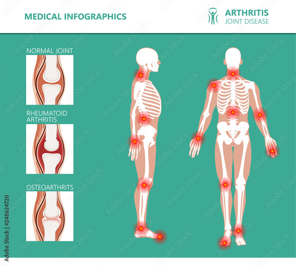 Rheumatism or rheumatic disorder medical posters. Arthritis joint pain