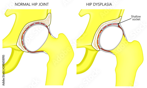 Vector illustration anatomy of a healthy human hip joint and hip with dysplasia. Front view. For advertising and medical publications photo