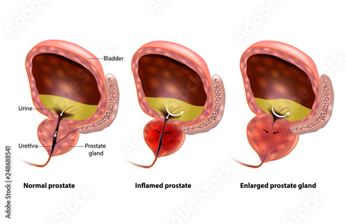 prostatic hyperplasia vásároljon egy peopling lövést a prosztatitisből