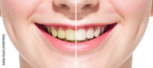 Bleaching of teeth. Before and after.