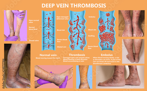 Economy class syndrome mechanism, deep vein thrombosis or DVT, Pulmonary Embolism, coronary thrombosis, diagram photo