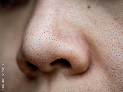 close up wide pores skin on dry face of Asian woman, Female nose and cheek skin problem, large pores, whitehead and blackhead pimple, nose photo
