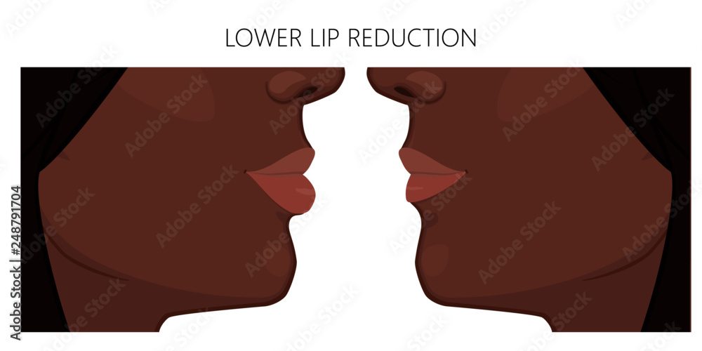 Vector illustration. African American lower lip reduction before, after
