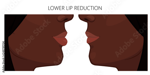 Vector illustration. African American lower lip reduction before, after procedure. Close up view. For advertising of cosmetic plastic procedures; for medical and beauty publications