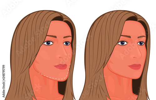 Vector illustration. A young white female face before and after plastic surgery - jaw reduction. Half-turned head. For advertising of plastic surgery, medical and beauty publications. photo