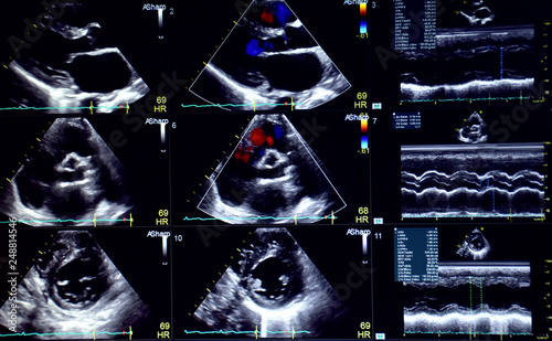  The 9 pictures of echocardiogram (ultrasound of haert).