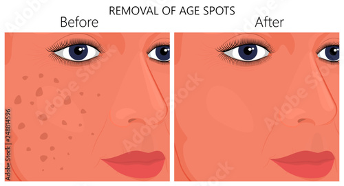 Vector illustration of a human face skin with age spots or melasma  before and after removal. For advertising, medical publications
