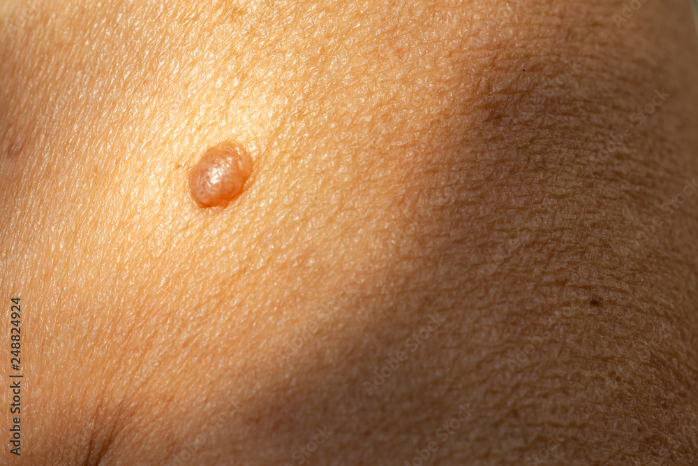 Brown mole on senior woman's brachium, Medicine, Close up & Macro shot, Selective focus, Light & Shadow, Body part, Healthcare concept Brown mole on senior woman's brachium, Medicine, Close up & Macro shot, Selective focus, Light & Shadow, Body part, Healthcare concept