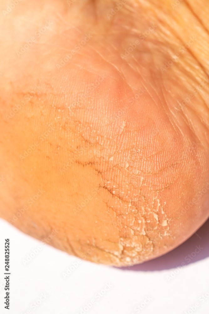 Fototapeta premium Woman' s heel break skin on white background, Close up & Macro shot, Asian Body skin part, Healthcare concept