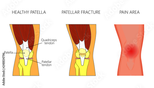 Vector illustration of a healthy knee joint and an unhealthy knee with displaced fracture of the patella. Anatomy, front view of the human knee. For advertising and medical publications