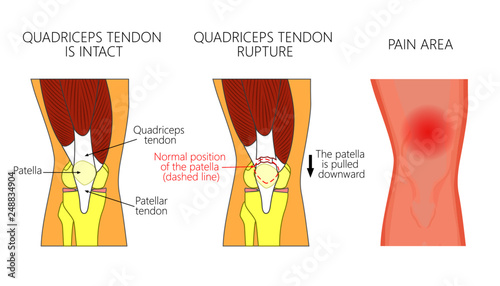 Vector illustration of a healthy knee joint and an unhealthy knee with a quadriceps tendon rupture problem. Anatomy, front view of the human knee.  For advertising and medical publications