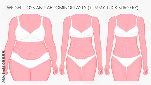 Vector illustration. Weight loss, abdominoplasty, tummy tuck plastic surgery in woman. Front view. For advertising of cosmetic plastic procedures, stomach shunting, diet; medical publications