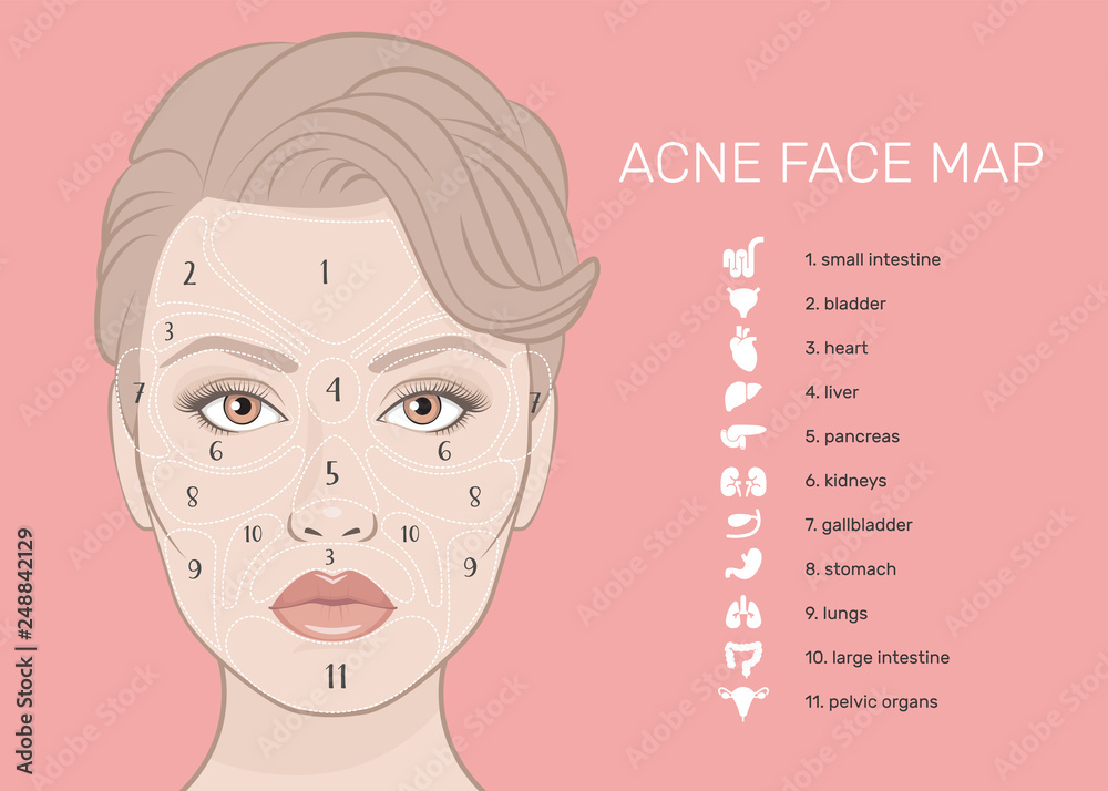Vecteur Stock Acne Face Map. Vector illustration of beauty woman face ...