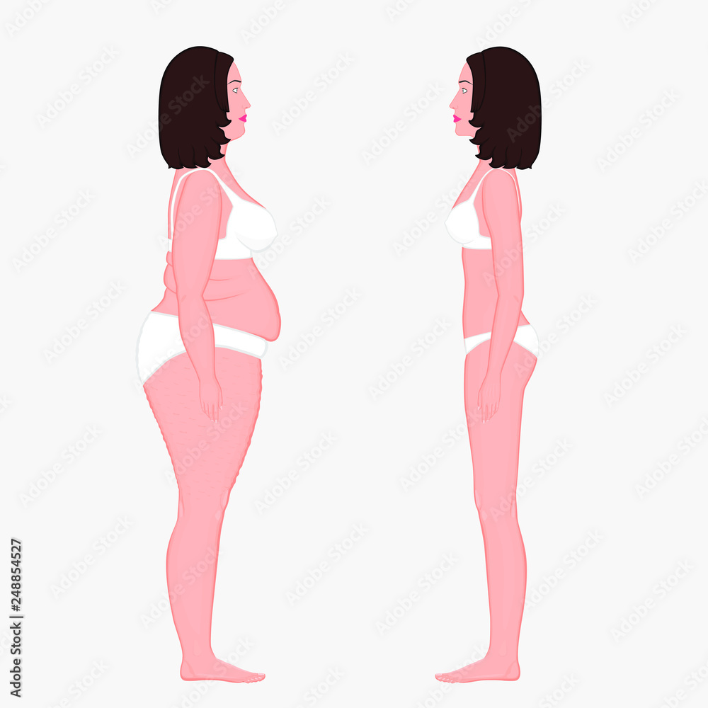 Vector illustration body weight loss in a European woman from obesity to normal. Front view. For advertising of cosmetic plastic procedures, stomach shunting, diet; medical publications Vector illustration body weight loss in a European woman from obesity to normal. Front view. For advertising of cosmetic plastic procedures, stomach shunting, diet; medical publications