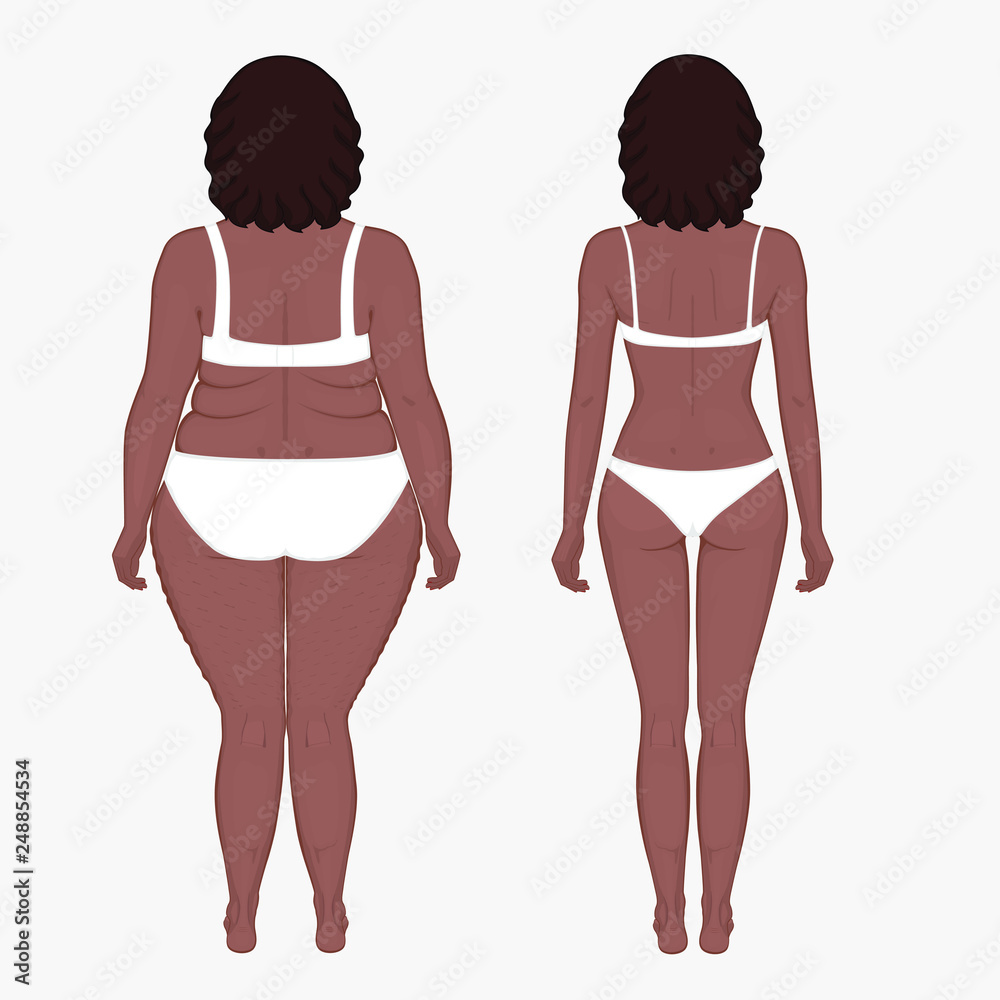 Vector illustration body weight loss in an African American woman from obesity to normal. Back view. For advertising of cosmetic plastic procedures, stomach shunting, diet; medical publications. Vector illustration body weight loss in an African American woman from obesity to normal. Back view. For advertising of cosmetic plastic procedures, stomach shunting, diet; medical publications.