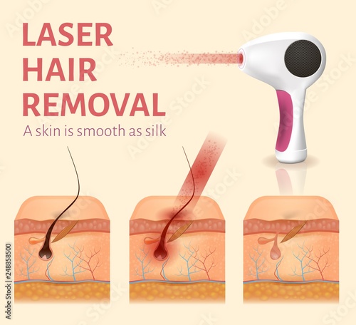 Illustration of Laser Hair Removal. Hair Follicles Undergoing Procedure. Advertising Banner for Woman. Laser Ray Burns Hair. Female Beauty Salon. Cosmetology Clinic Concept. Vector EPS 10.