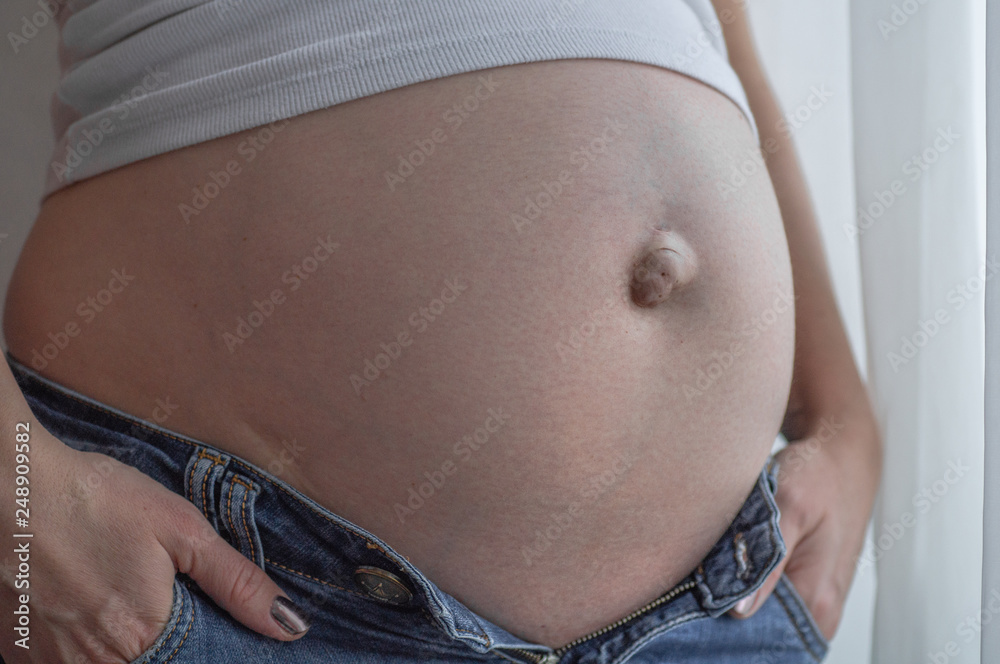 Umbilical hernia in a pregnant woman. Closeup - obrazy, fototapety, plakaty 