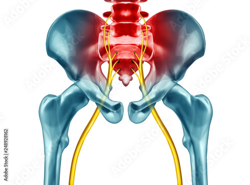 Canvastavla Sciatic Nerve Pain