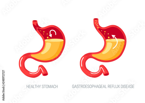 GERD concept in flat style, vector illustration