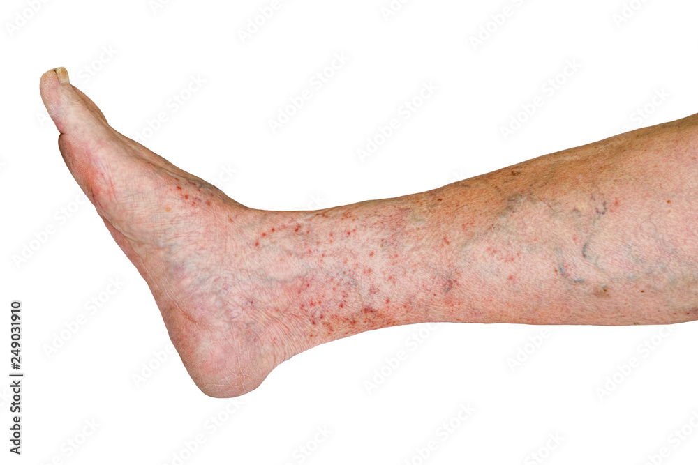 Old woman's leg with varicose disease, varicose veins isolated on white  background, Stock Photo