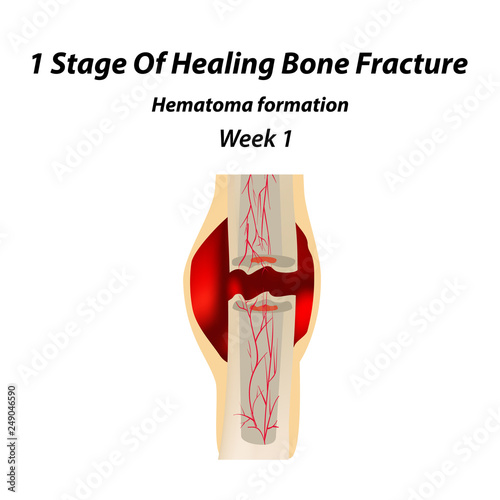 1 Stage Of Healing Bone Fracture. Formation of callus. The bone fracture. Infographics. Vector illustration on isolated background.