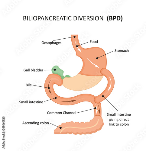 Biliopancreatic diversion (bpd) photo