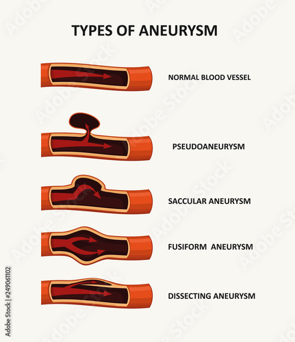 Types of aneurysm