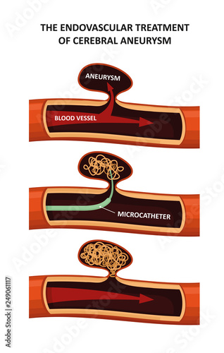The endovascular treatment
