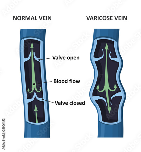 Varicose vein and normal vein