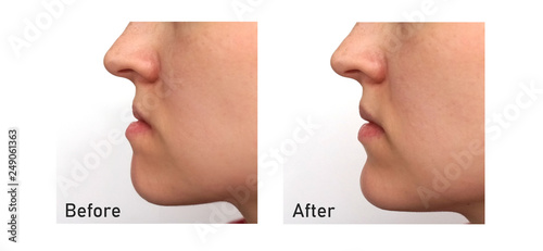 Orthognathic Surgery. Jaw Surgery. Malocclusion